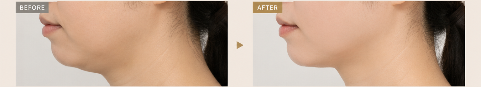 ハイフ Before / After