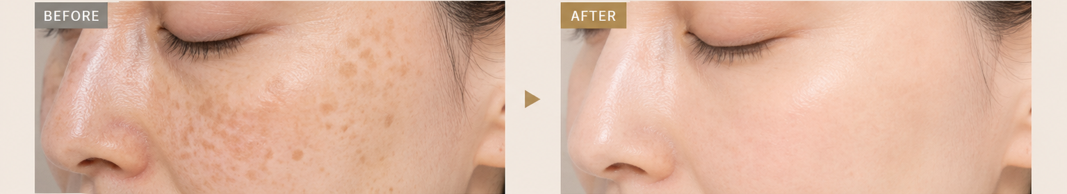 ピコレーザー Before / After